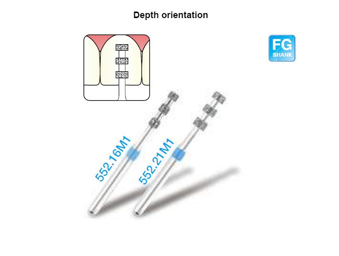 Knife edge [Removing labial surface depth 0.3 mm or 0.5 mm instruction ditch]